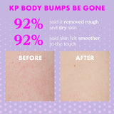 KP Body Bumps Be Gone With 10% AHA
